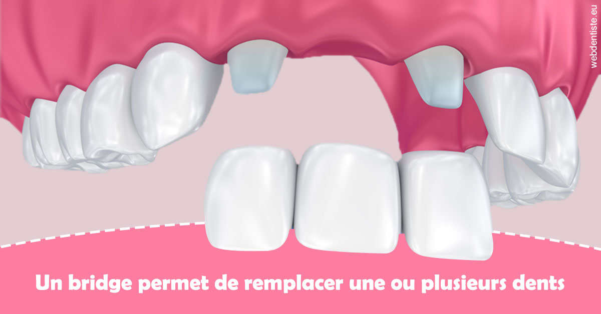 https://dr-carine-ben-younes-uzan.chirurgiens-dentistes.fr/Bridge remplacer dents 2