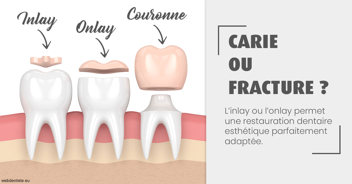 https://dr-carine-ben-younes-uzan.chirurgiens-dentistes.fr/T2 2023 - Carie ou fracture 1