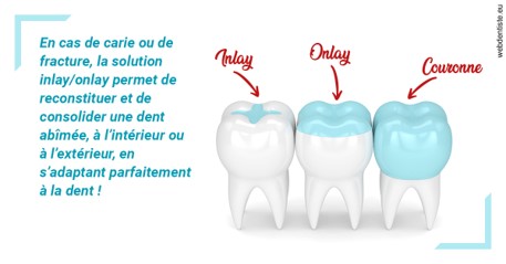 https://dr-carine-ben-younes-uzan.chirurgiens-dentistes.fr/L'INLAY ou l'ONLAY