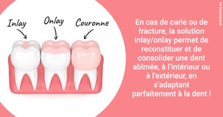 https://dr-carine-ben-younes-uzan.chirurgiens-dentistes.fr/L'INLAY ou l'ONLAY 2