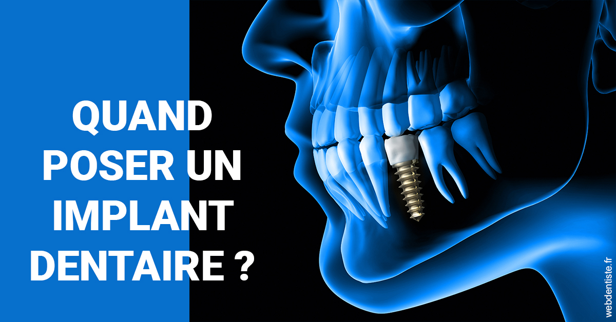 https://dr-carine-ben-younes-uzan.chirurgiens-dentistes.fr/Les implants 1