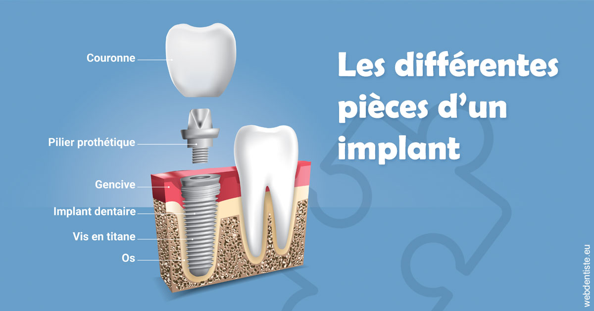 https://dr-carine-ben-younes-uzan.chirurgiens-dentistes.fr/Les différentes pièces d’un implant 1